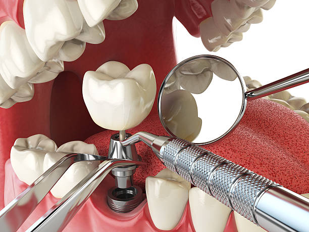 Best Emergency Treatment for Toothache in La Cresta, CA